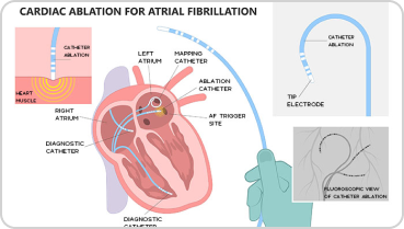 Atrial fibrillation ablation